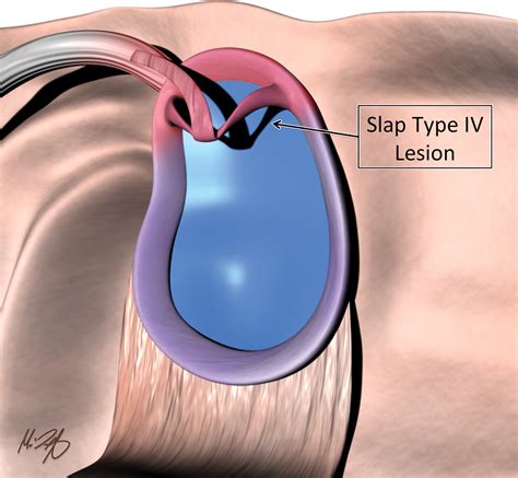 shoulder labrum tear